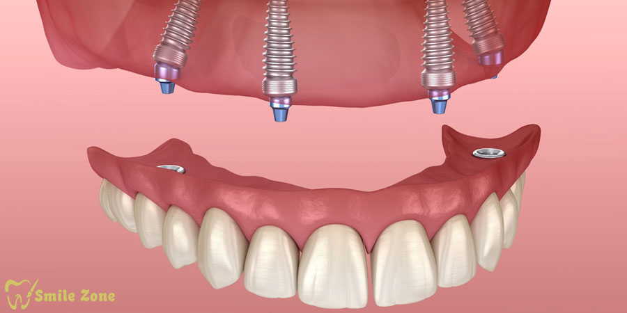 مزایا و معایب ایمپلنت فول فک؛ درک این روش دندانپزشکی متحول کننده