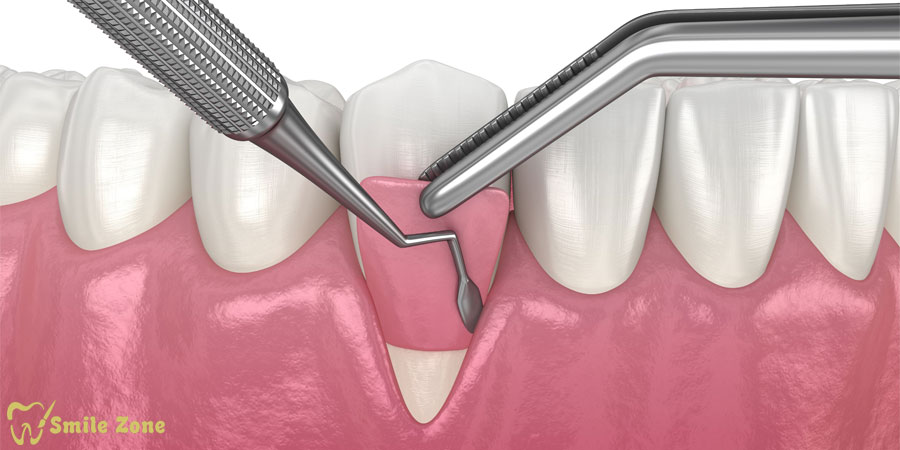 لیفت لثه در مقابل جراحی لثه؛ تفاوت‌ها و کاربردها