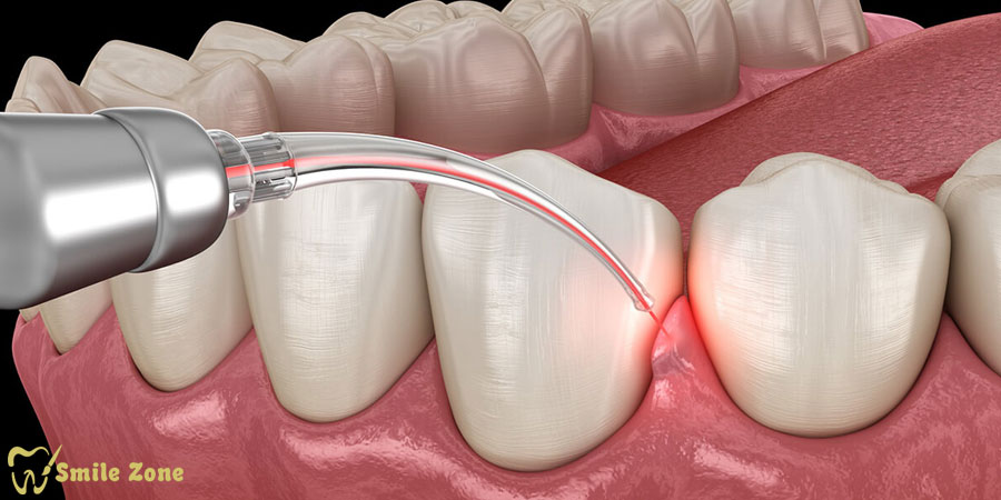 انقلاب لیفت لثه با لیزر و فناوری‌های مدرن