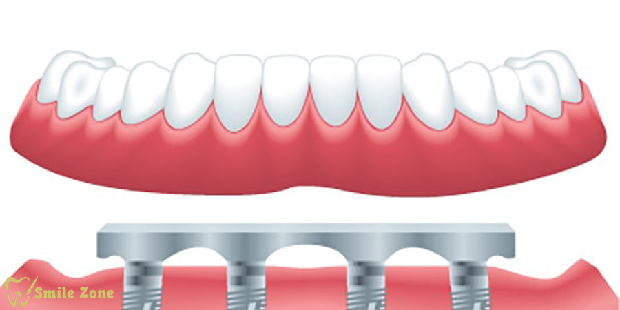 انقلابی در ترمیم دندان؛ هر آنچه که باید در مورد اوردنچر بدانید